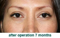 plastic-surgery-blepharoplasty